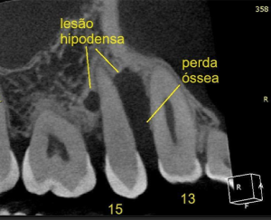2, 3 e 4 | Diferentes planos tomográficos, evidenciando a real extensão da lesão.