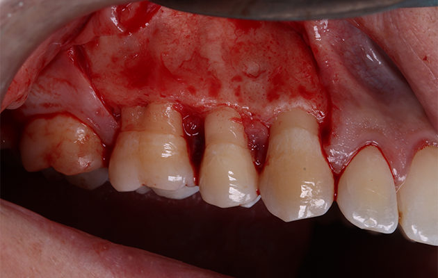 6 e 7 | Descolamento vestibular e janela de acesso à lesão.