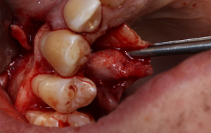 8 e 9 | Acesso palatino e início da enucleação.