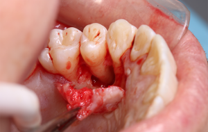 8 e 9 | Acesso palatino e início da enucleação.