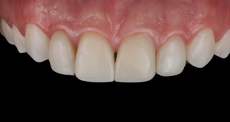 1 | Aspecto inicial intrabucal com resina composta insatisfatória nos dentes 12, 11, 21 e 22.