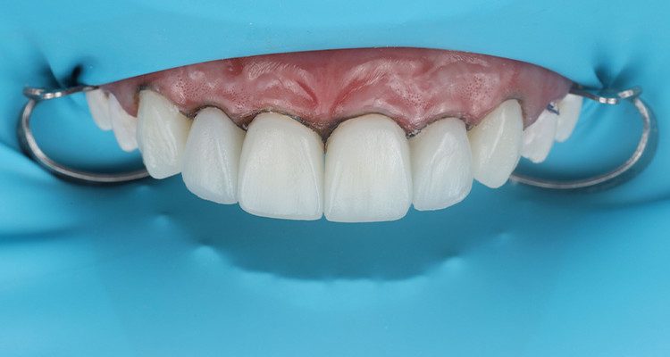 10 | Camada vestibular com resina Vittra APS esmalte, na cor EBL3.