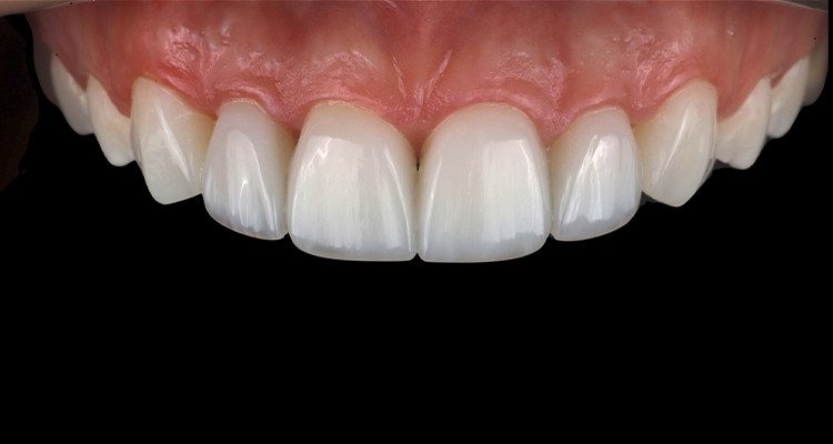 11 | Aspecto final das restaurações após acabamento e polimento.