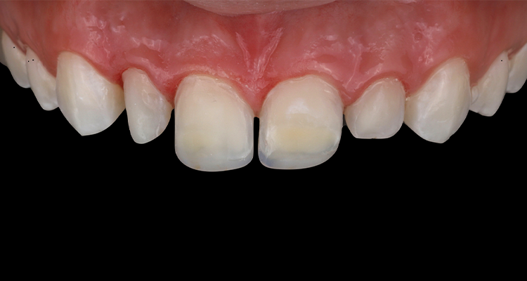 2 | Aspecto após a remoção parcial das resinas prévias