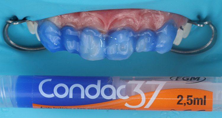 3 | Condicionamento ácido total de superfície com Condac 37, com isolamento absoluto modificado e fios retratores posicionados.