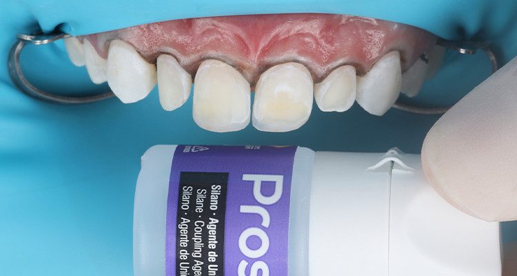 4 | Aplicação de silano Prosil por 1 minuto sobre as resinas que foram mantidas