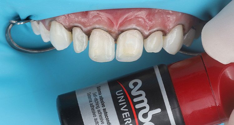 5 | Aplicação do adesivo Ambar Universal APS, sobre toda a superfície a ser restaurada