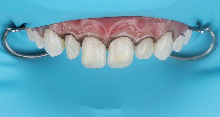 6 | Aplicação do sistema adesivo prévio ao início do procedimento restaurador.