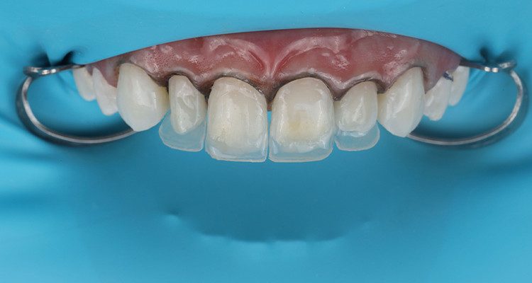 7 | Concha palatina confeccionada com resina composta Vittra APS, na cor Trans N