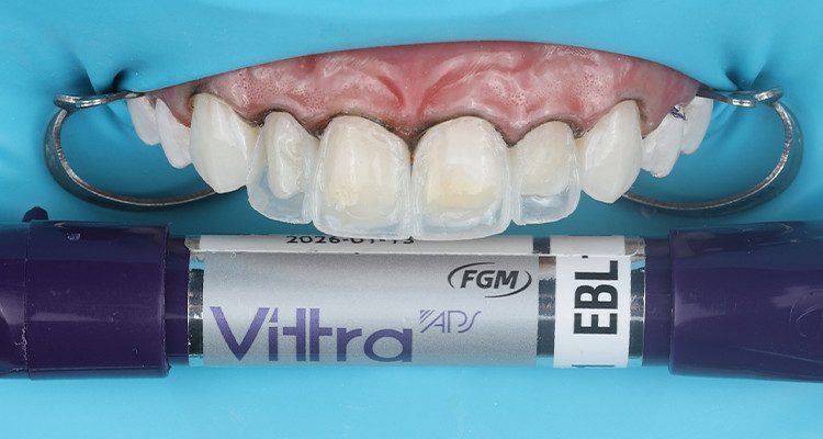 8 | Confecção das cristas marginais Vittra APS, esmalte na cor EBL3.