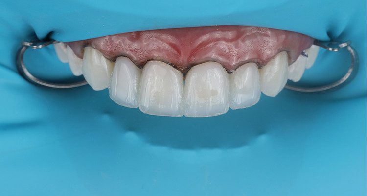 9 | incremento da camada facetas de dentina e confecção dos mamelos com Vittra APS, na cor DBL3.