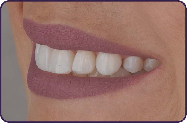 n3 final sorriso lateral estetica - Kit Estética