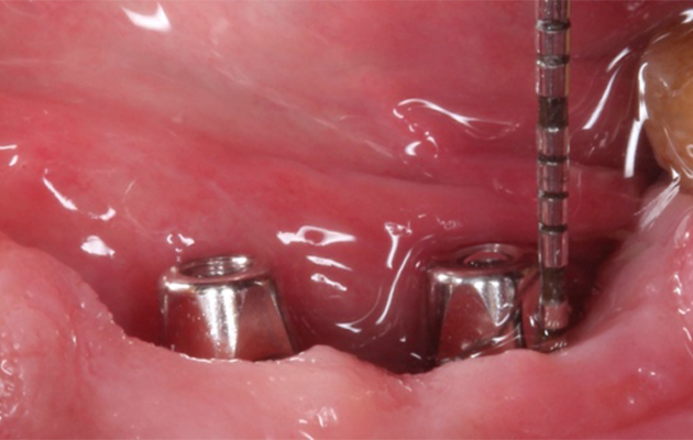 1 e 2 | Estabilidade e condicionamento tecidual imediato durante a instalação da peça protética definitiva.