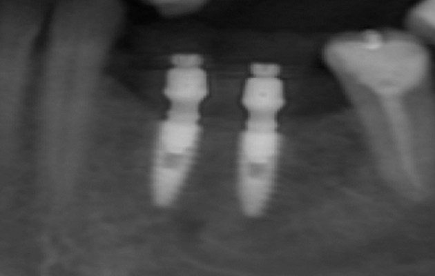 1 e 2 | Estabilidade e condicionamento tecidual imediato durante a instalação da peça protética definitiva.