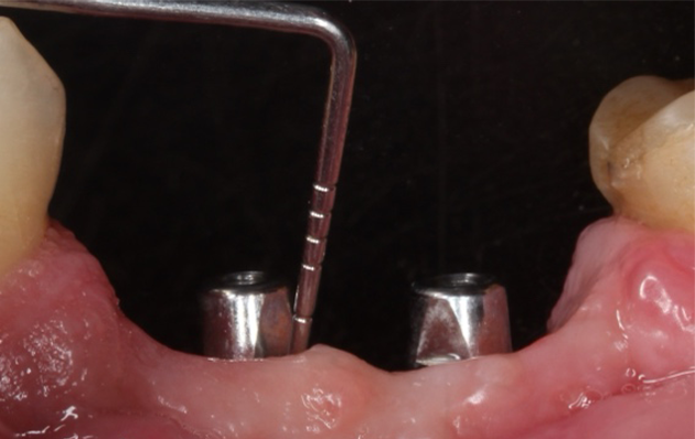 3 e 4 | Acompanhamento clínico e radiográfico com dois anos em função.