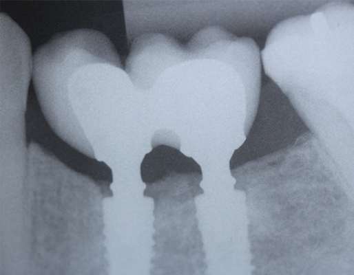 3 e 4 | Acompanhamento clínico e radiográfico com dois anos em função.