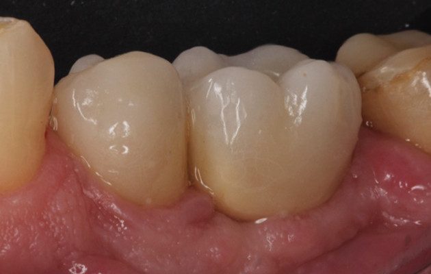 5 e 6 | Acompanhamento clínico e radiográfico com nove anos em função.