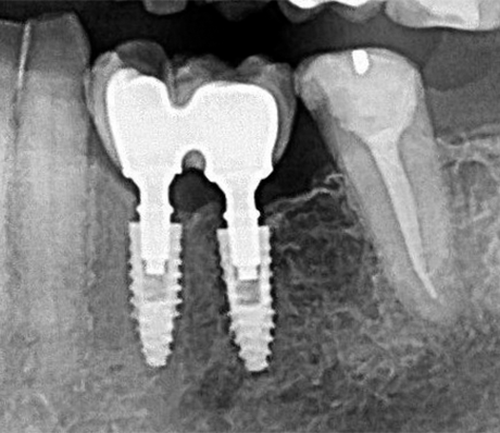 5 e 6 | Acompanhamento clínico e radiográfico com nove anos em função. Arcsys, implantes
