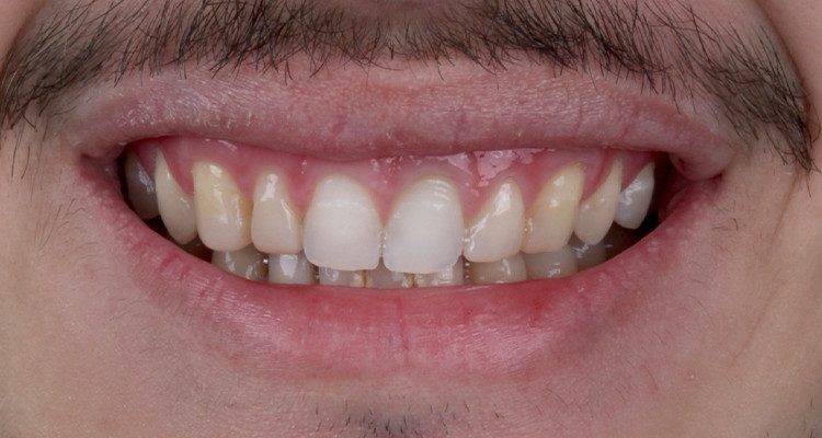 1 | Sorriso Inicial.