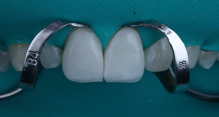 10 | Isolamento absoluto.