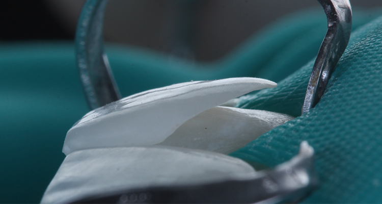 11 | Prova das facetas após o isolamento.