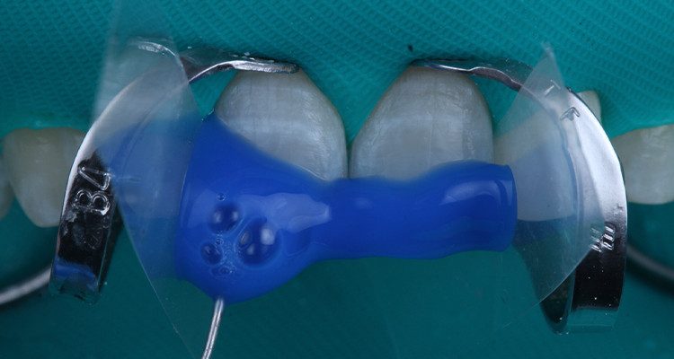 13 e 14 | Condicionamento do esmalte dental por 30s.