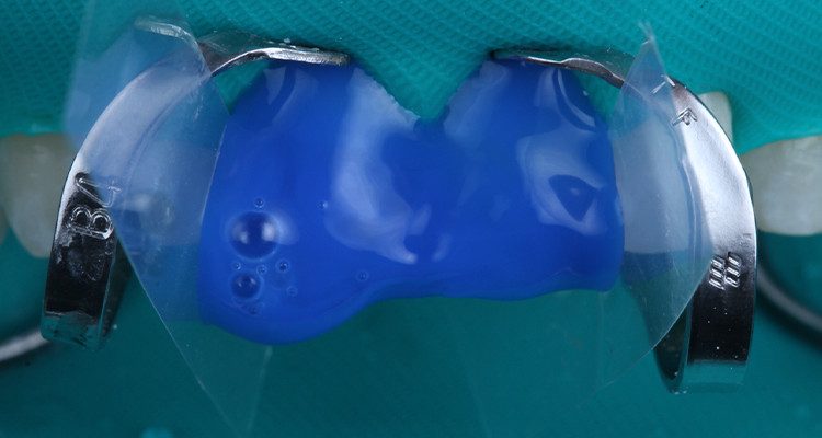 13 e 14 | Condicionamento do esmalte dental por 30s.