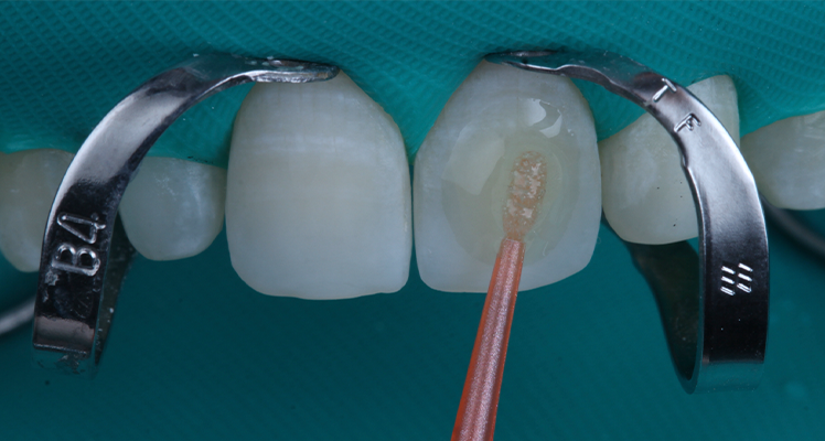 16 | Facetas posicionadas sobre os dentes após a remoção dos excessos do agente cimentante.