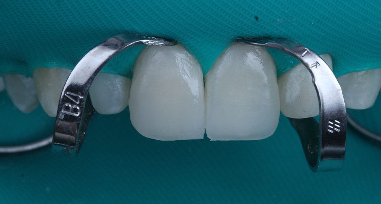 16 | Facetas posicionadas sobre os dentes após a remoção dos excessos do agente cimentante.