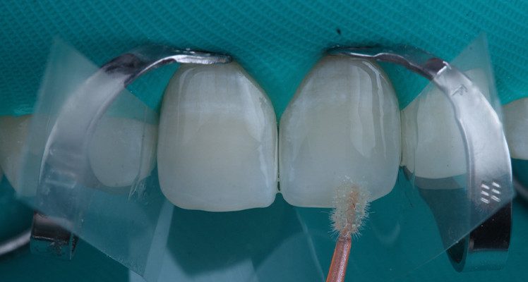 17 e 18 | Aplicação do adesivo Ambar APS