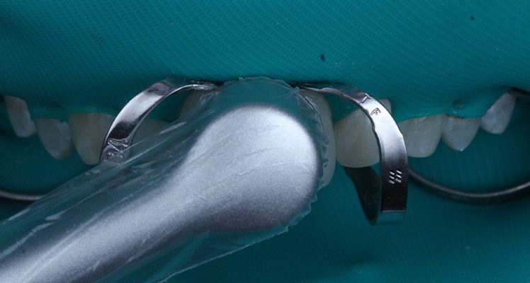 19, 20 e 21 | Fotoativação com luz de alta intensidade Quazar.