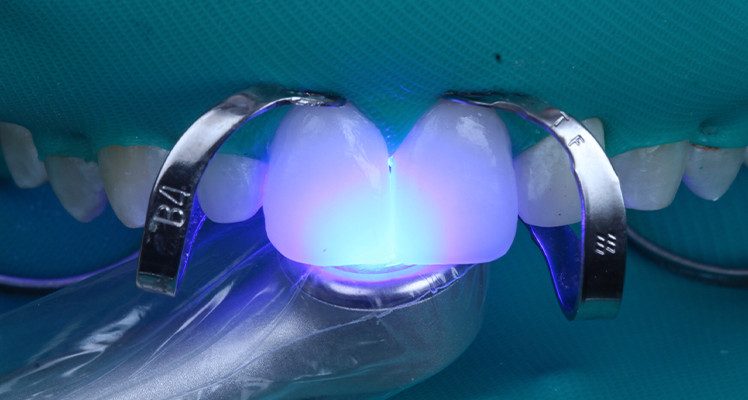 19, 20 e 21 | Fotoativação com luz de alta intensidade Quazar.