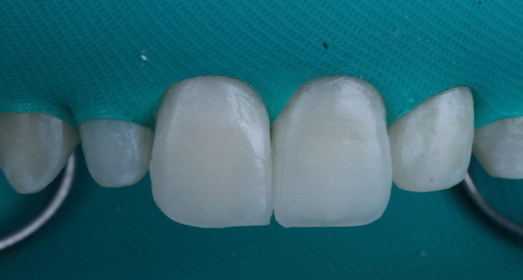 22 | Facetas cimentadas