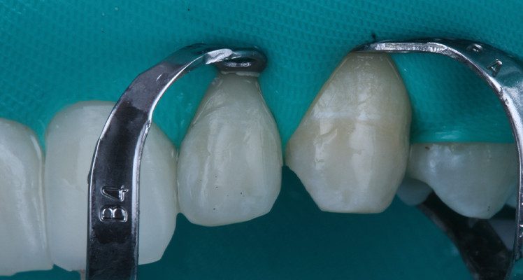 23 | Isolamento dos dentes 22 e 23