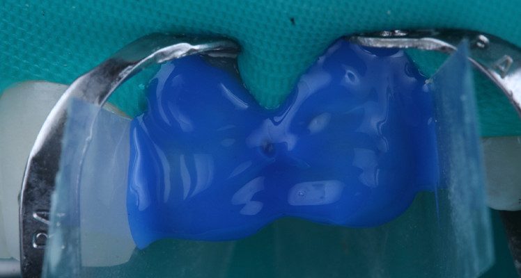 24 | Condicionamento do esmalte dental por 30 segundos