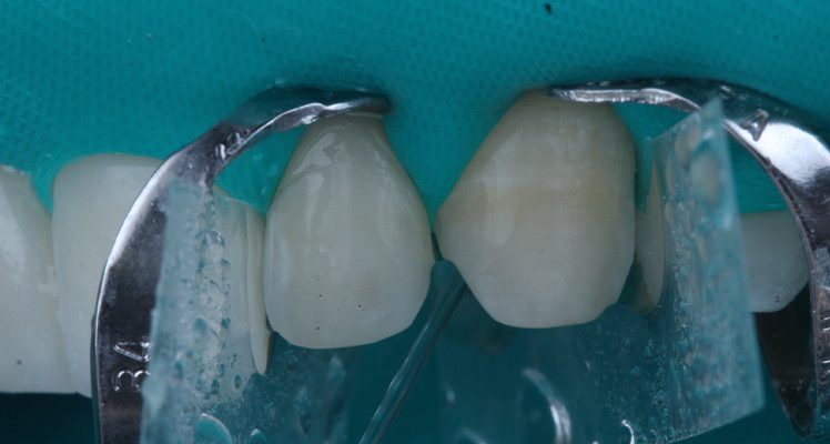 25 | Lavagem por 30 segundos.