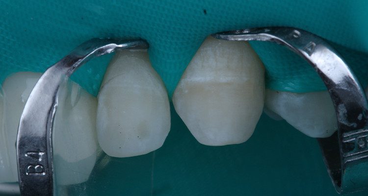 26 | Esmalte condicionado.