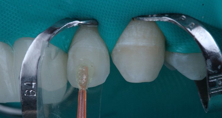 27 e 28 | Aplicação do adesivo Ambar APS.