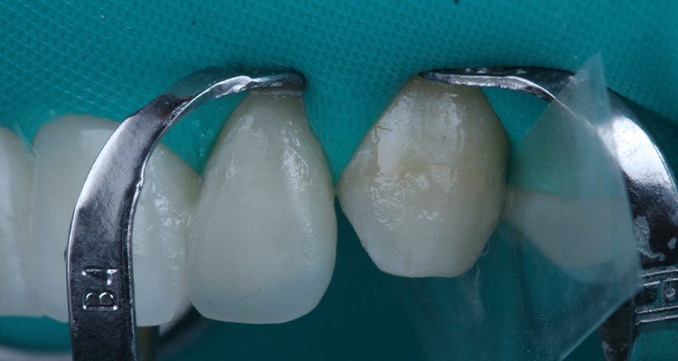 29 | Cimentação da faceta do dente 22.