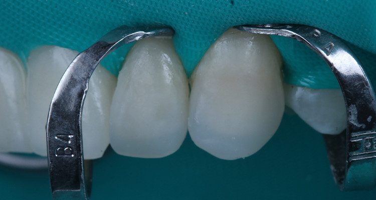 30 | Cimentação da faceta do dente 23.