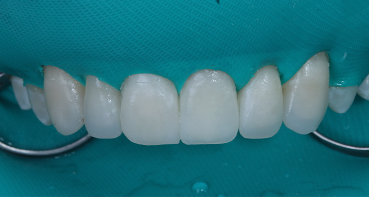 31 | Facetas cimentadas.