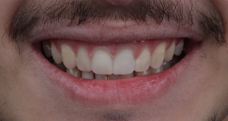 3 | Mockup utilizando a resina PrimmaArt, na cor A1.