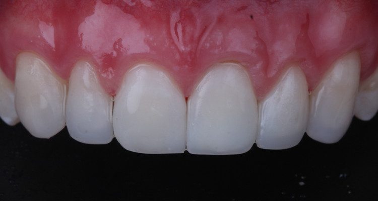 32 | Aspecto após acabamento e polimento.