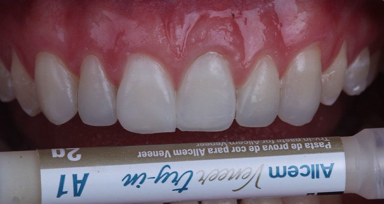 9 | Prova das facetas com cimento de prova Allcem Veneer Try-in, cor E-Bleach M.