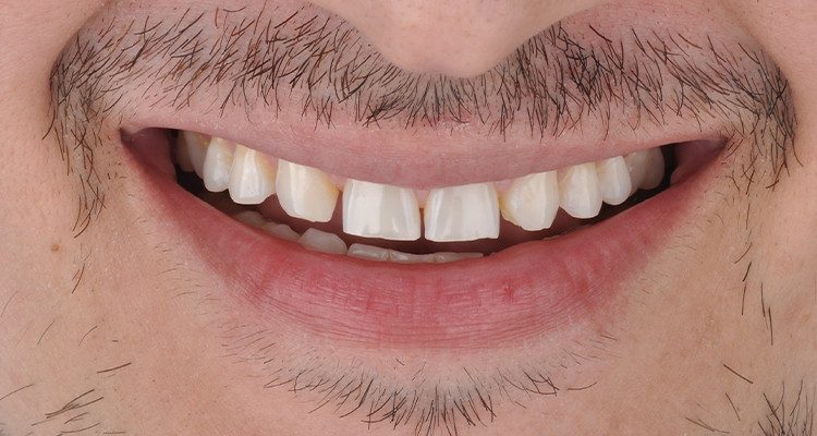 Caso 18 1 - Laminados Cerâmicos para Reabilitação Estética 1A | Aspecto inicial do sorriso do paciente.