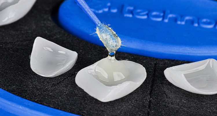 Caso 18 10 - Laminados Cerâmicos para Reabilitação Estética 9 | Aplicação do adesivo Ambar Universal APS Plus nos laminados cerâmicos.