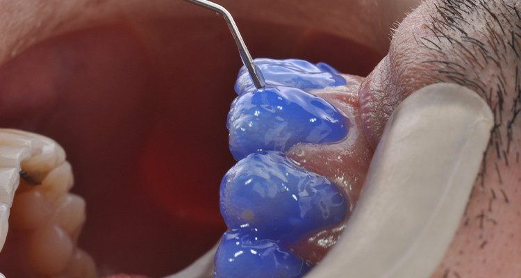 Caso 18 11 - Laminados Cerâmicos para Reabilitação Estética 10 | Aplicação do ácido fosfórico Condac 37.