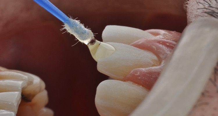 Caso 18 12 - Laminados Cerâmicos para Reabilitação Estética 11 | Após condicionamento dos dentes com Condac 37, foi realizada a aplicação do adesivo Ambar Universal APS Plus.