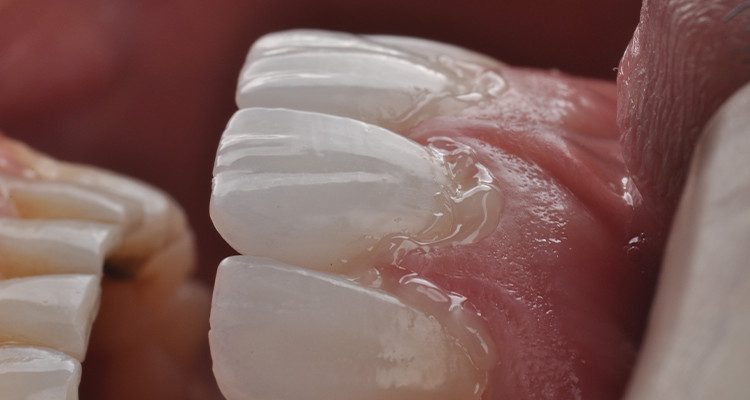 Caso 18 13 - Laminados Cerâmicos para Reabilitação Estética 12A e 12B | Cimentação com Allcem Veneer APS Trans, remoção dos excessos e fotoativação com Quazar.