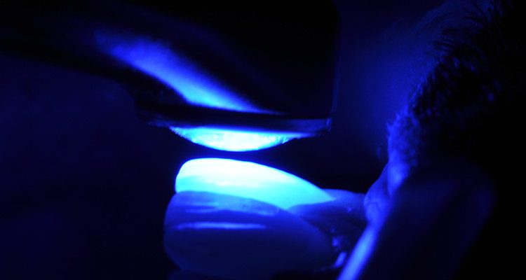 Caso 18 14 - Laminados Cerâmicos para Reabilitação Estética 12A e 12B | Cimentação com Allcem Veneer APS Trans, remoção dos excessos e fotoativação com Quazar.